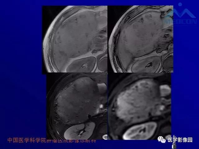 【PPT】肝脏富血供肿瘤CT、MRI诊断