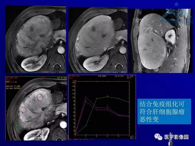 【PPT】肝脏富血供肿瘤CT、MRI诊断