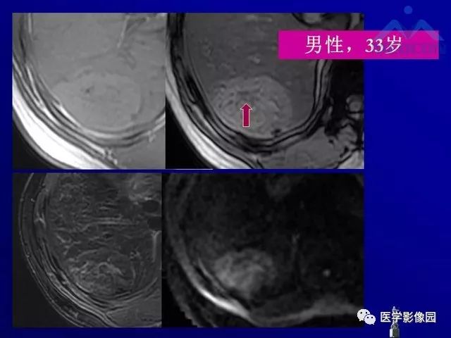 【PPT】肝脏富血供肿瘤CT、MRI诊断