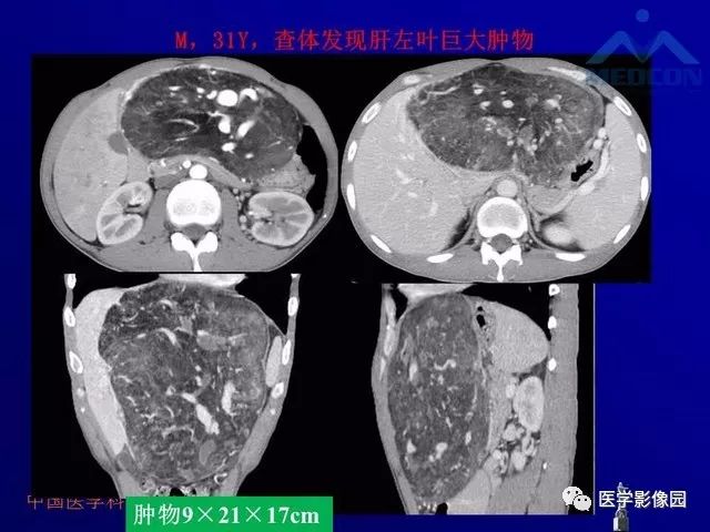 【PPT】肝脏富血供肿瘤CT、MRI诊断