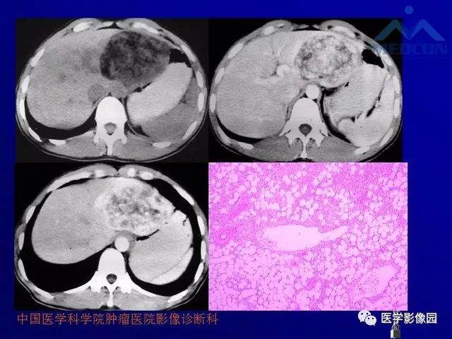 【PPT】肝脏富血供肿瘤CT、MRI诊断