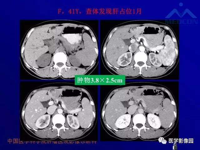 【PPT】肝脏富血供肿瘤CT、MRI诊断