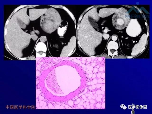 【PPT】肝脏富血供肿瘤CT、MRI诊断