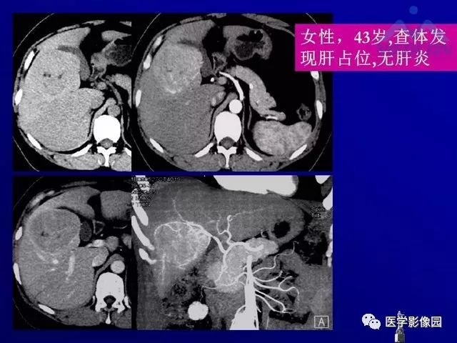 【PPT】肝脏富血供肿瘤CT、MRI诊断