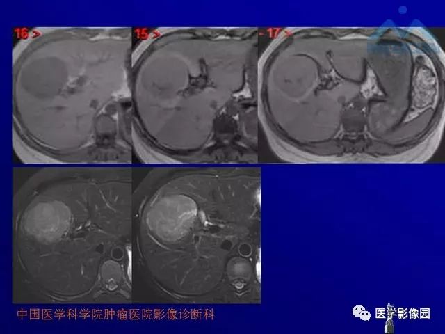 【PPT】肝脏富血供肿瘤CT、MRI诊断