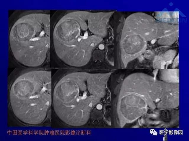 【PPT】肝脏富血供肿瘤CT、MRI诊断
