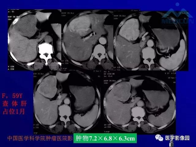 【PPT】肝脏富血供肿瘤CT、MRI诊断