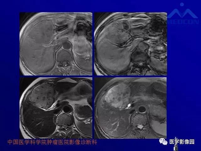【PPT】肝脏富血供肿瘤CT、MRI诊断