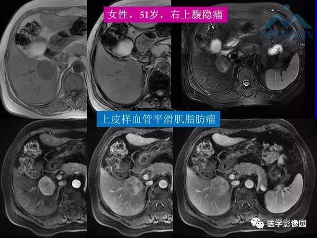 【PPT】肝脏富血供肿瘤CT、MRI诊断
