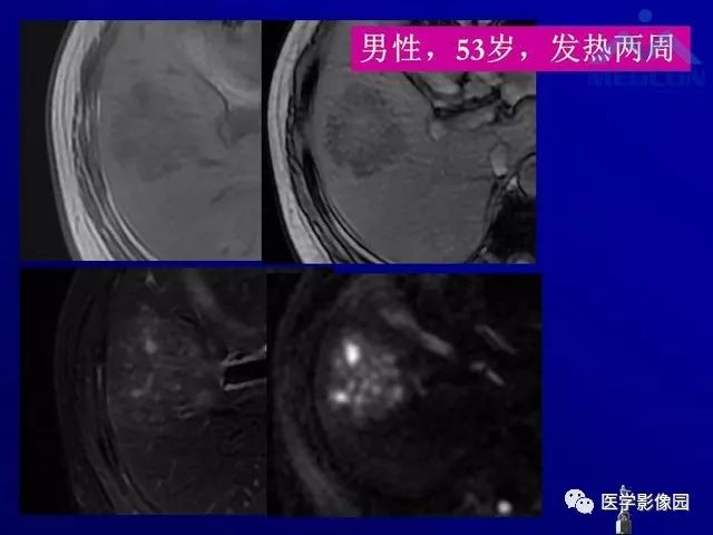 【PPT】肝脏富血供肿瘤CT、MRI诊断