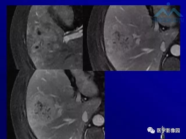 【PPT】肝脏富血供肿瘤CT、MRI诊断