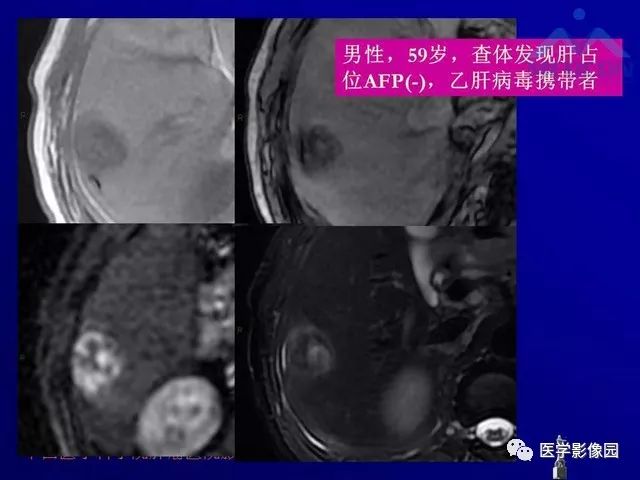 【PPT】肝脏富血供肿瘤CT、MRI诊断