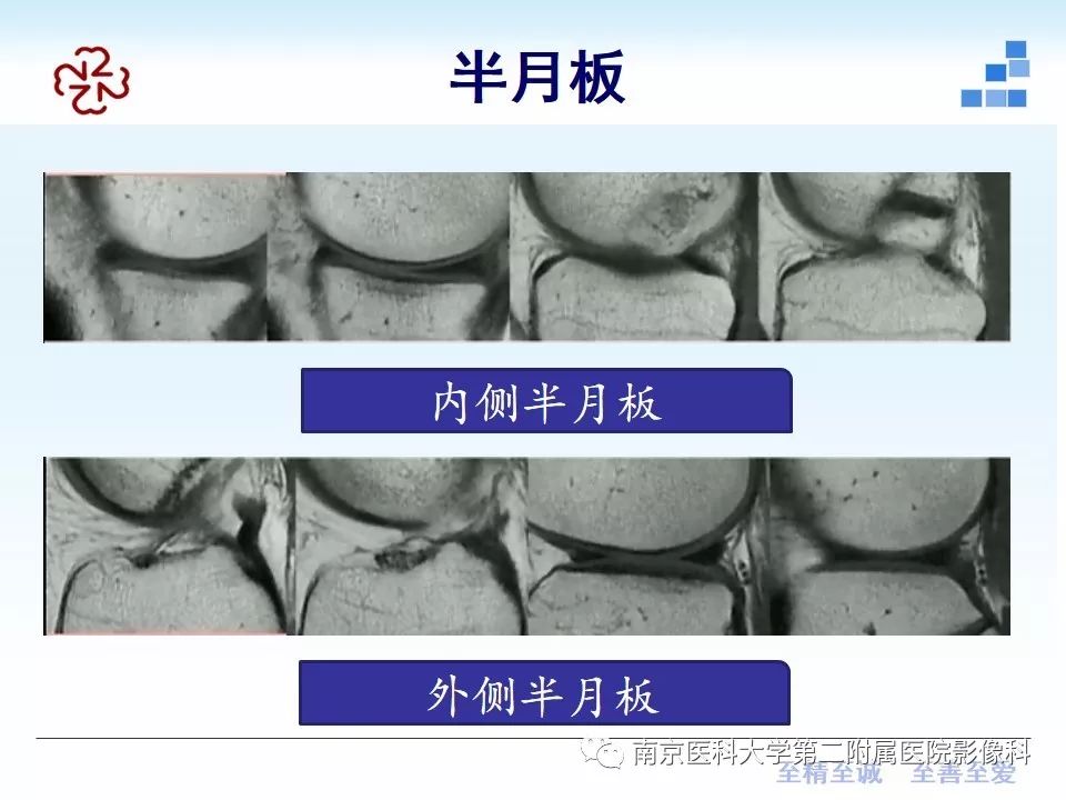 【PPT】膝关节运动损伤的MR表现