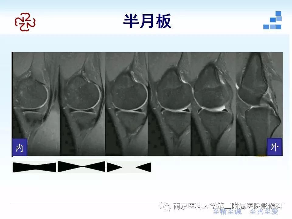 【PPT】膝关节运动损伤的MR表现
