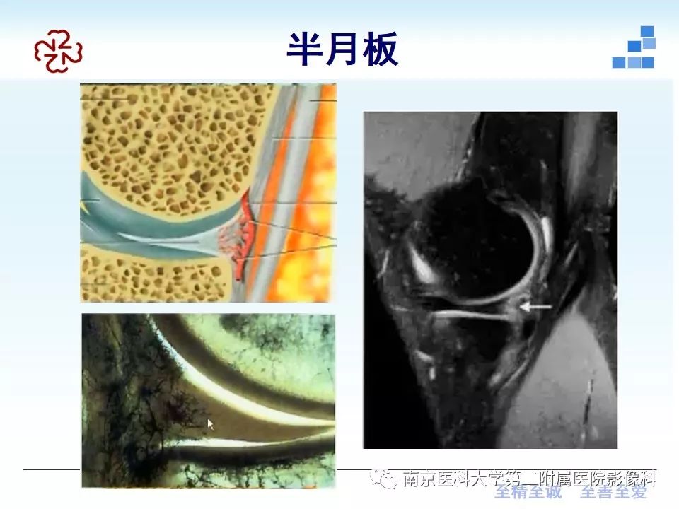 【PPT】膝关节运动损伤的MR表现