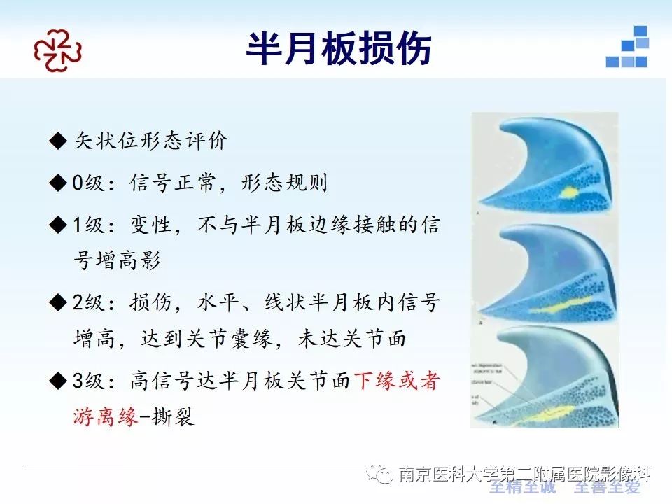 【PPT】膝关节运动损伤的MR表现