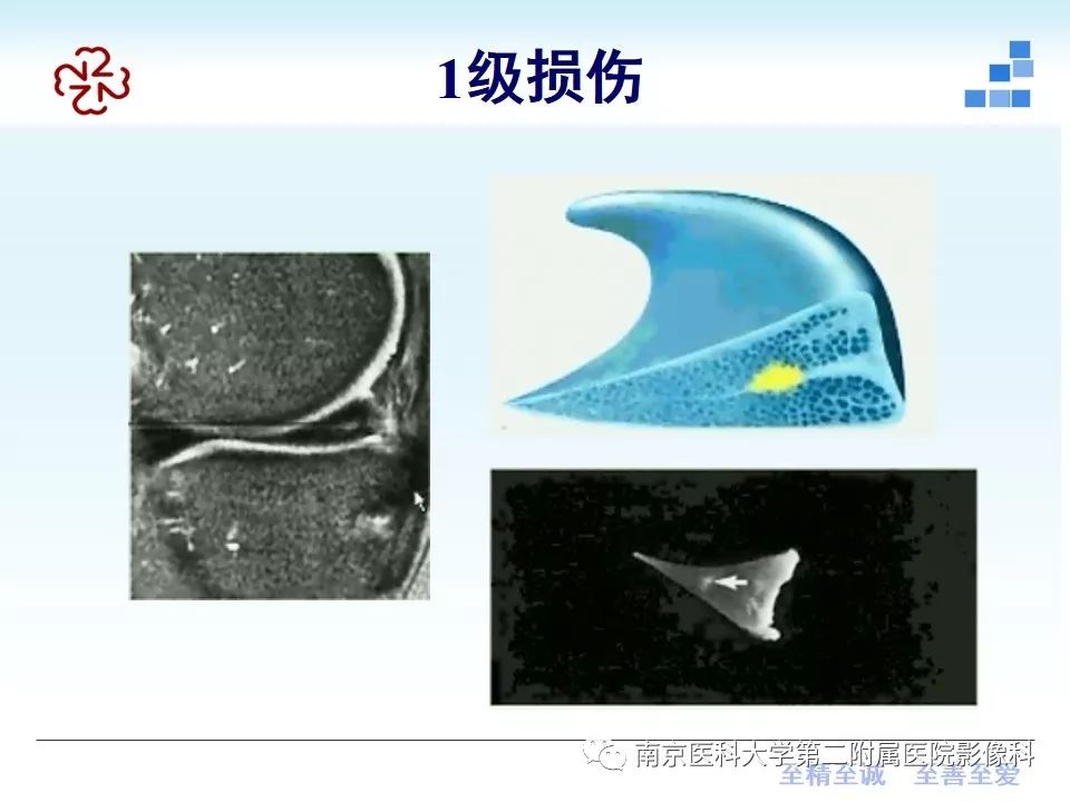 【PPT】膝关节运动损伤的MR表现
