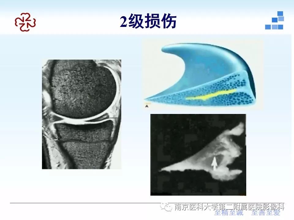 【PPT】膝关节运动损伤的MR表现