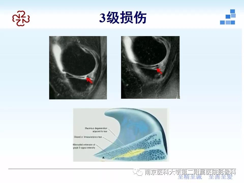 【PPT】膝关节运动损伤的MR表现