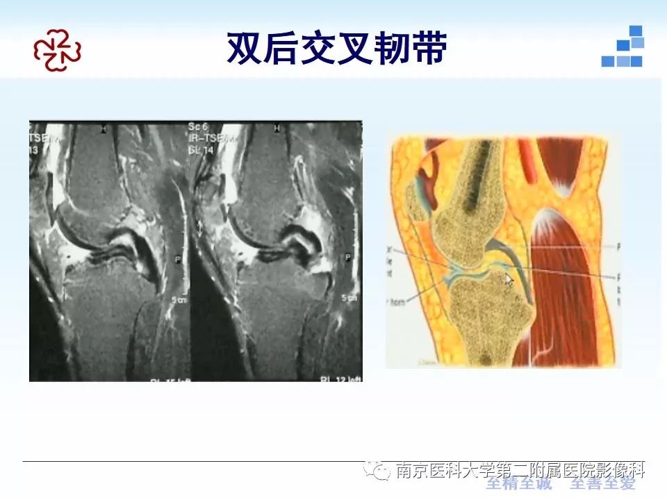 【PPT】膝关节运动损伤的MR表现