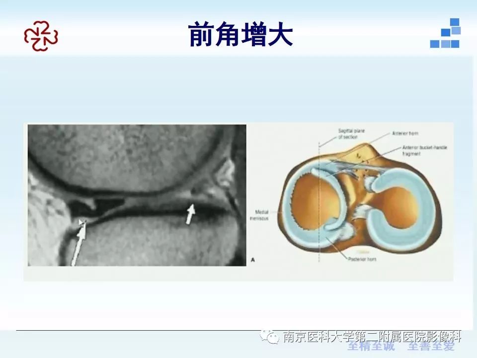【PPT】膝关节运动损伤的MR表现