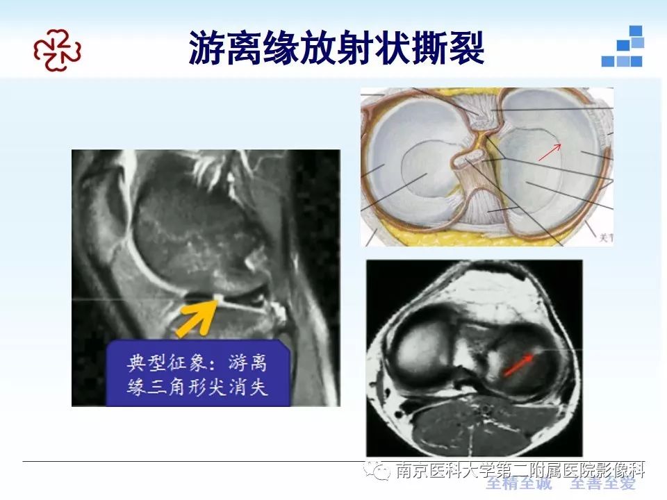 【PPT】膝关节运动损伤的MR表现