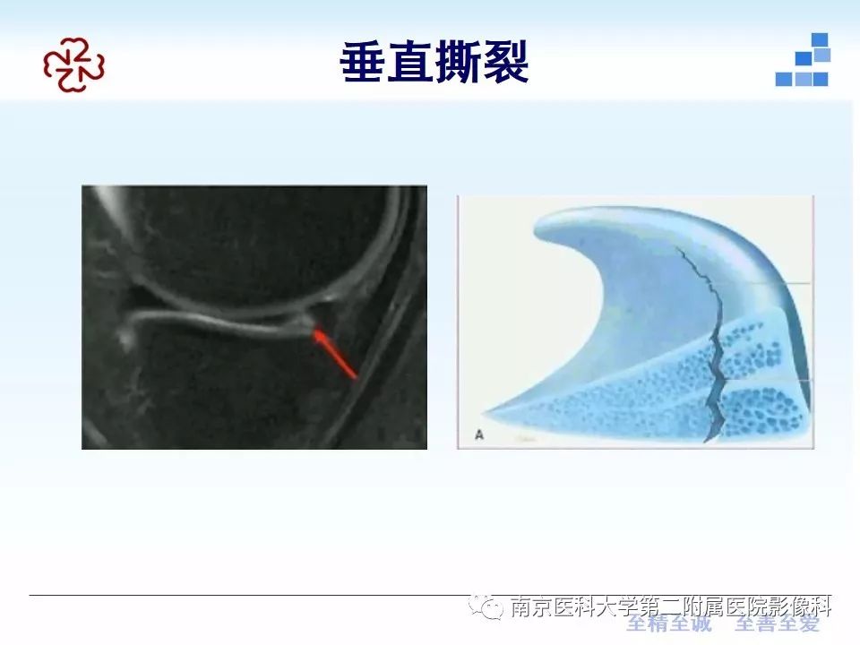 【PPT】膝关节运动损伤的MR表现