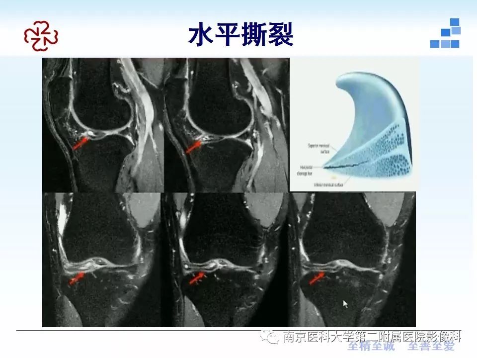 【PPT】膝关节运动损伤的MR表现