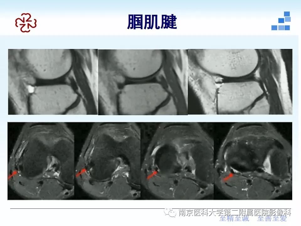 【PPT】膝关节运动损伤的MR表现