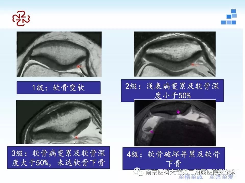【PPT】膝关节运动损伤的MR表现