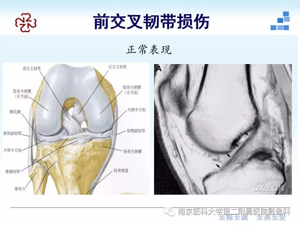 【PPT】膝关节运动损伤的MR表现