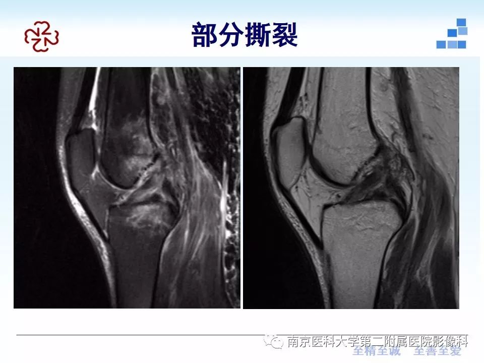 【PPT】膝关节运动损伤的MR表现