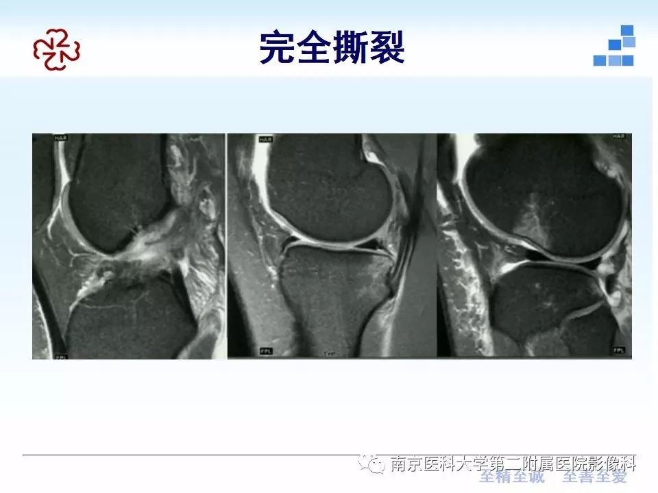 【PPT】膝关节运动损伤的MR表现