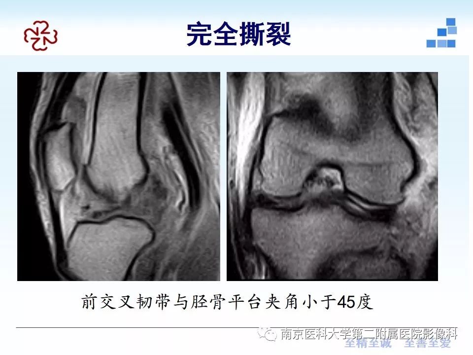 【PPT】膝关节运动损伤的MR表现
