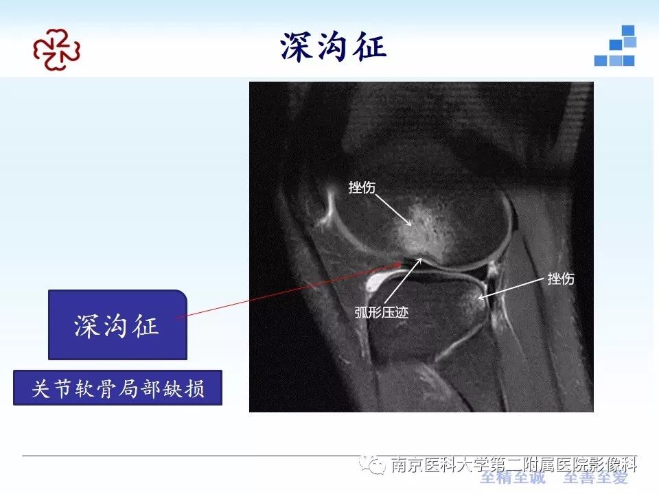 【PPT】膝关节运动损伤的MR表现