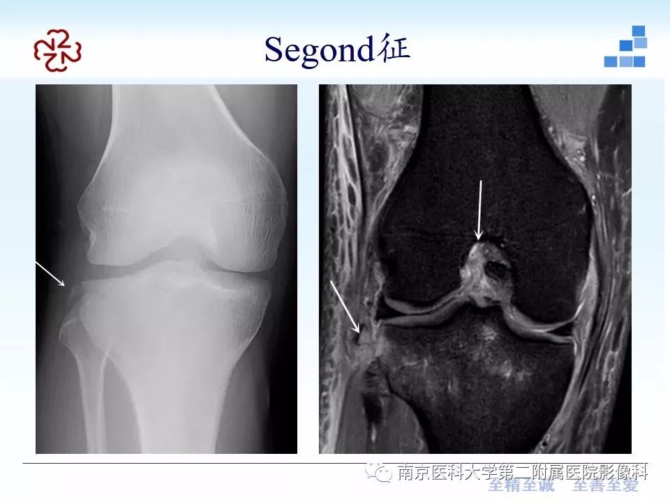 【PPT】膝关节运动损伤的MR表现