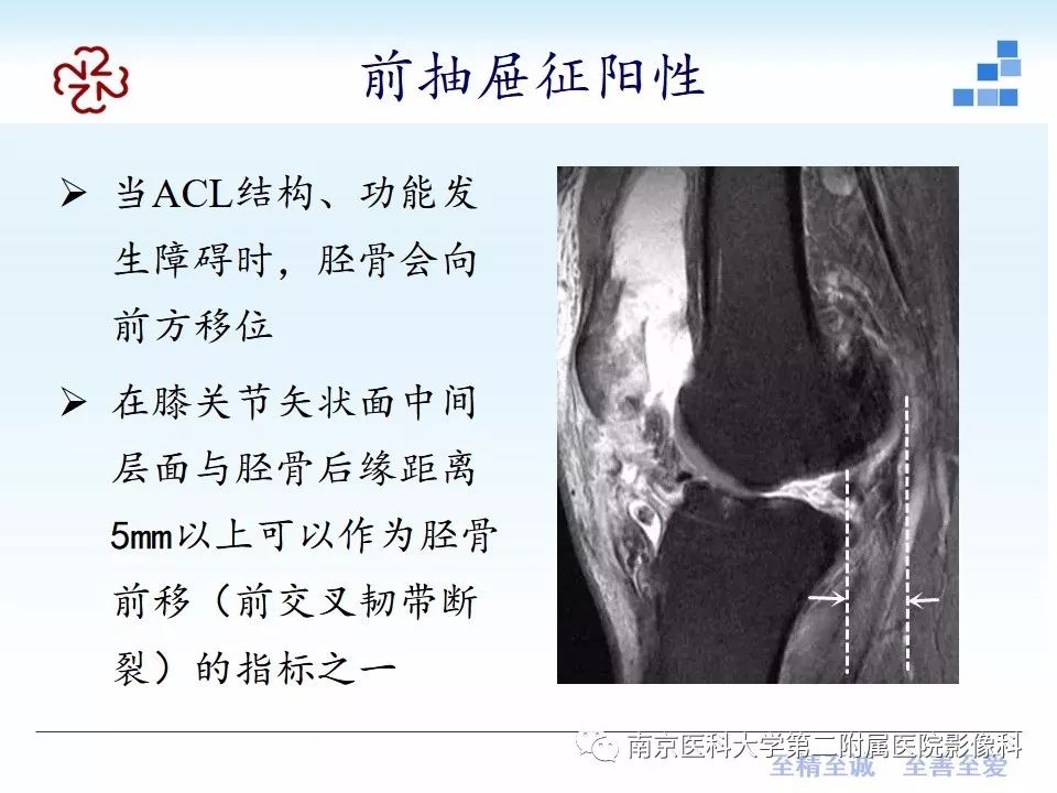 【PPT】膝关节运动损伤的MR表现