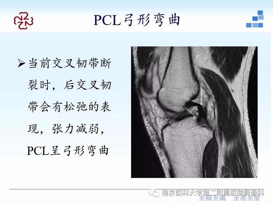【PPT】膝关节运动损伤的MR表现