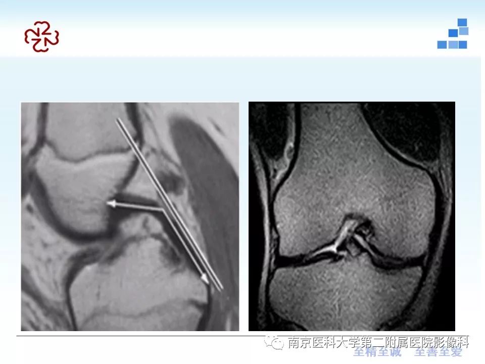 【PPT】膝关节运动损伤的MR表现