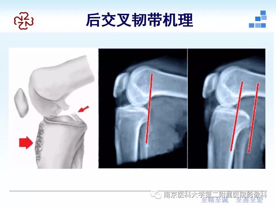 【PPT】膝关节运动损伤的MR表现
