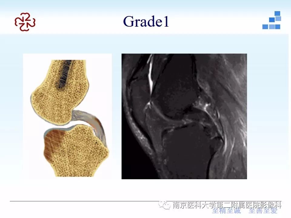 【PPT】膝关节运动损伤的MR表现