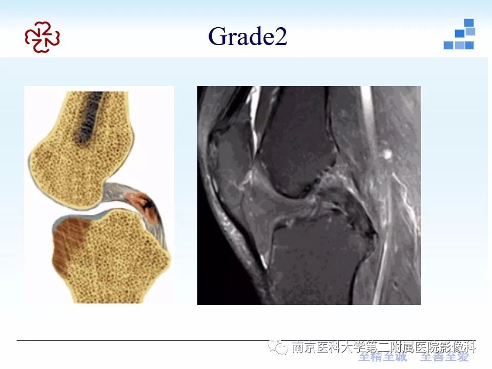 【PPT】膝关节运动损伤的MR表现