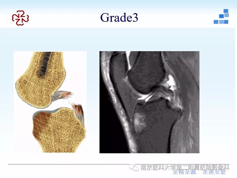 【PPT】膝关节运动损伤的MR表现