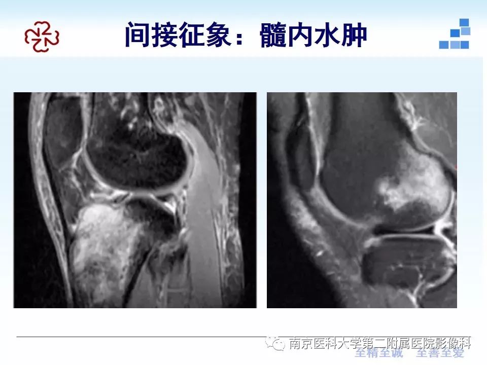 【PPT】膝关节运动损伤的MR表现