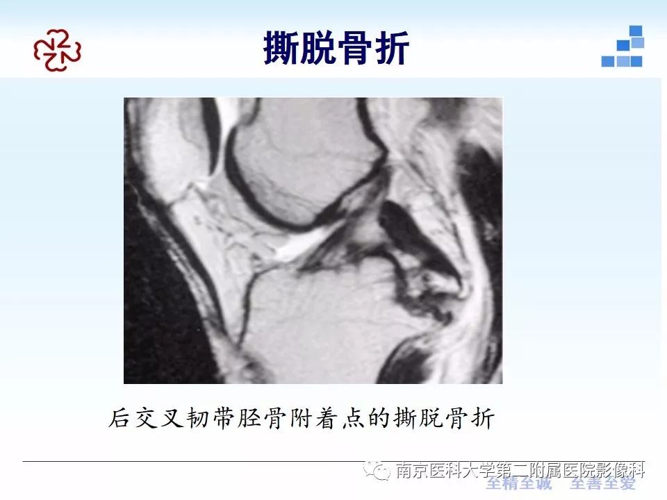 【PPT】膝关节运动损伤的MR表现