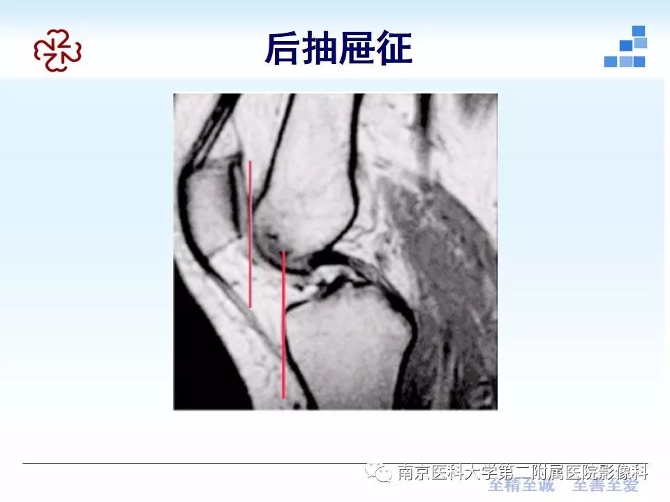 【PPT】膝关节运动损伤的MR表现