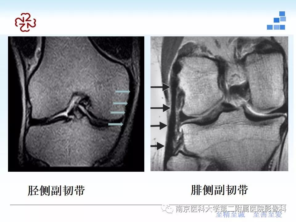 【PPT】膝关节运动损伤的MR表现