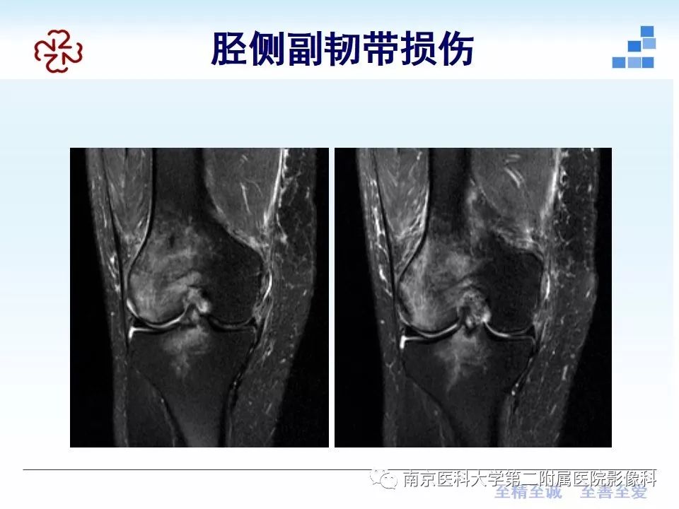 【PPT】膝关节运动损伤的MR表现