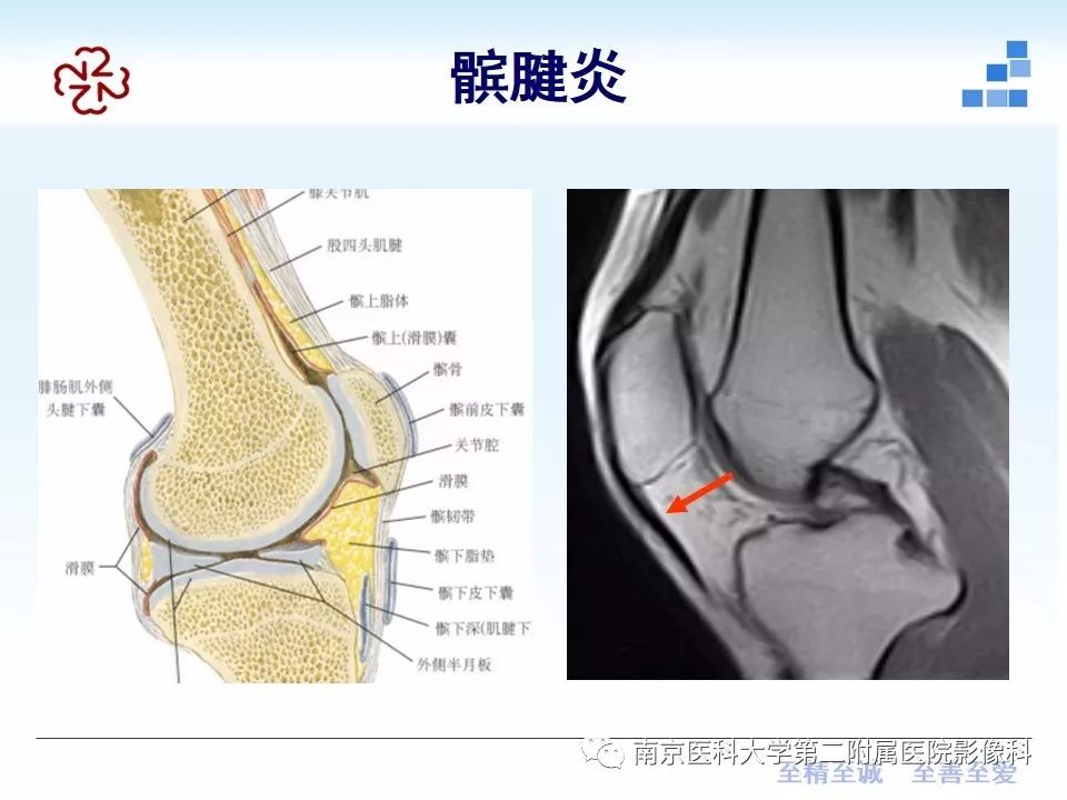 【PPT】膝关节运动损伤的MR表现