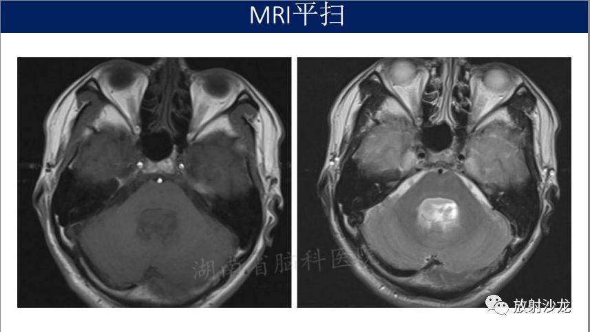 【病例】四脑室室管膜瘤1例MR影像表现